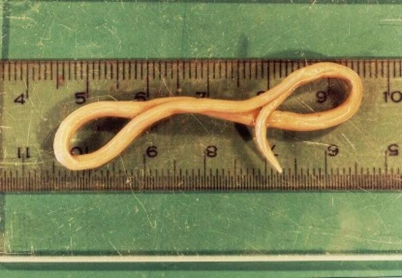 Ronnworm Parasit aus dem mënschleche Kierper