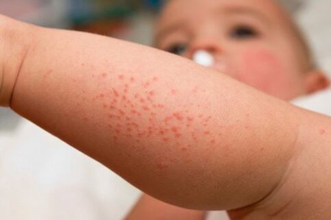Allergie bei engem Kand als Symptom vun der Präsenz vu Würmern