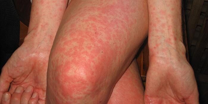 Symptomer vu Parasiten am Kierper
